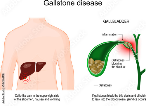 gallstone disease. Cross section of Gallbladder with Gallstones photo