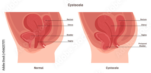 Cystocele. Female urogenital system disease. Dropped or prolapsed