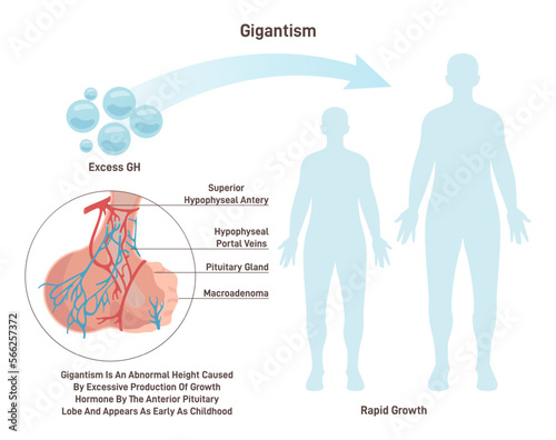 Gigantism. Syndrome characterized by excessive secretion of growth