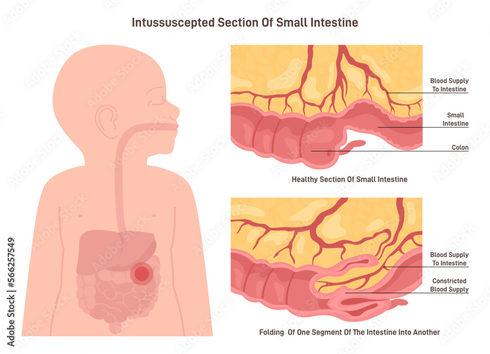 Intersection Intestinal Intussusception. Congenital condition in which part of the intestine ...