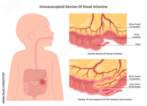 Intussusception. Congenital condition in which part of the intestine photo