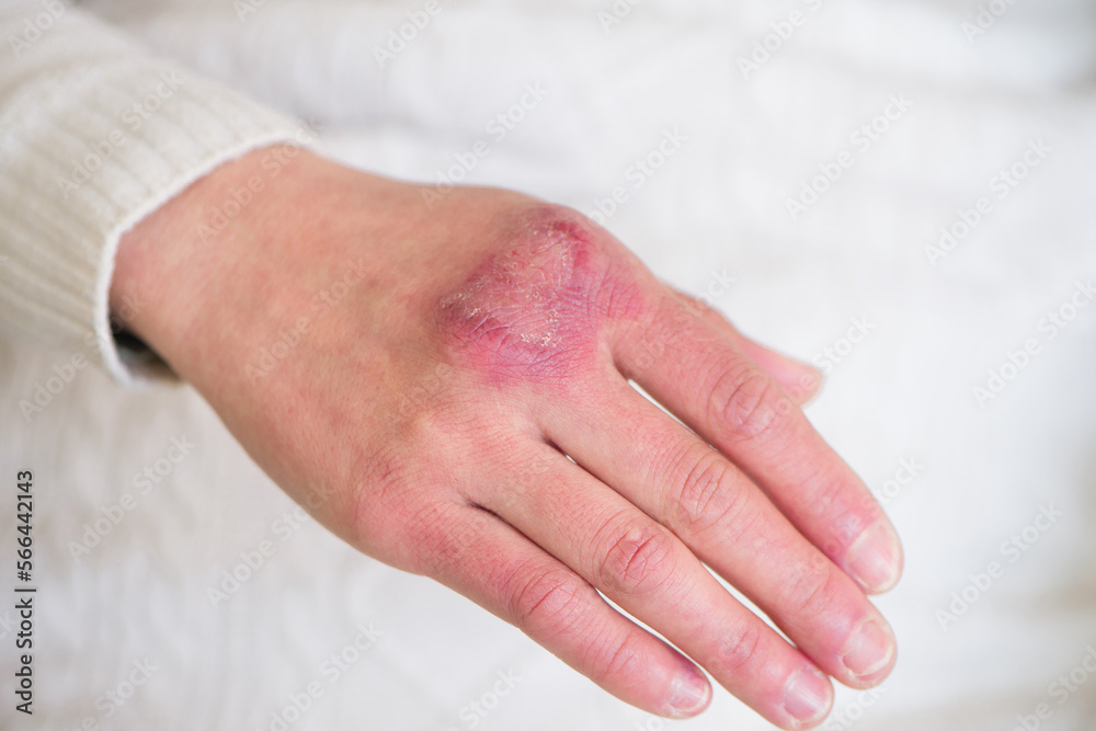 Fototapeta premium close up of female hand with chilblain 