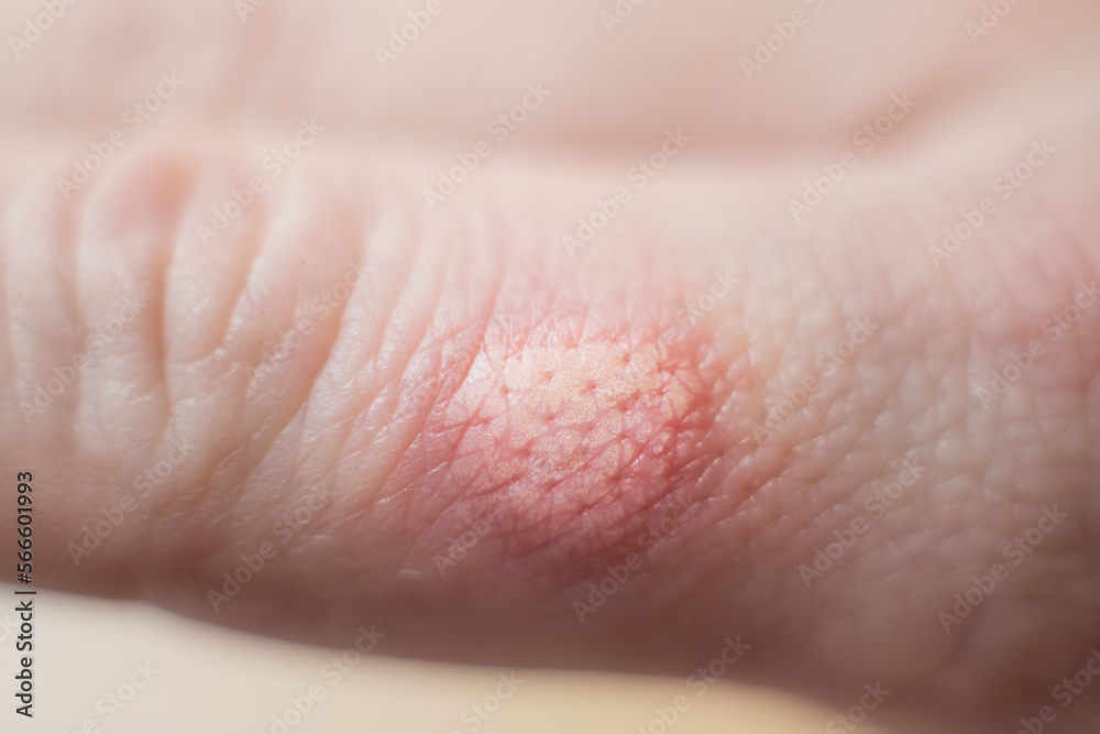 Burned skin on a finger of Caucasians man hand - closeup Burned skin on a finger of Caucasians man hand - closeup