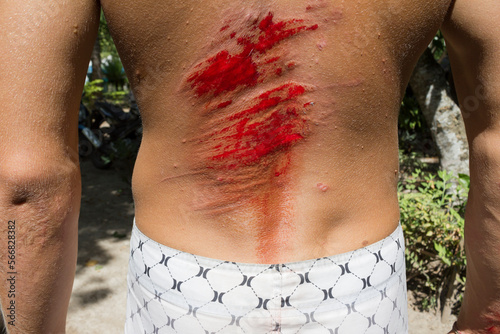 Open bloody wound on back of man after surf incident, Lombok, Sumbawa, Indonesia