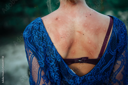 mosquito bites the back of a girl