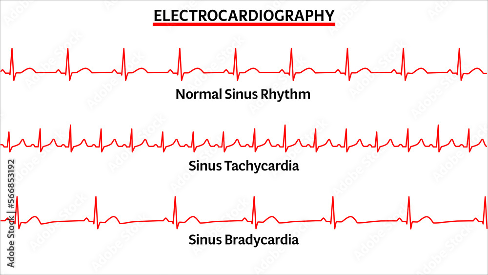 Set of ECG Common Abnormalities Normal Sinus Rhythm Sinus