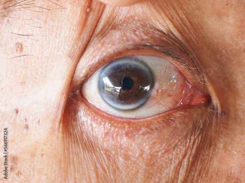 Close up eye arcus senilis disease in elderly man. photo