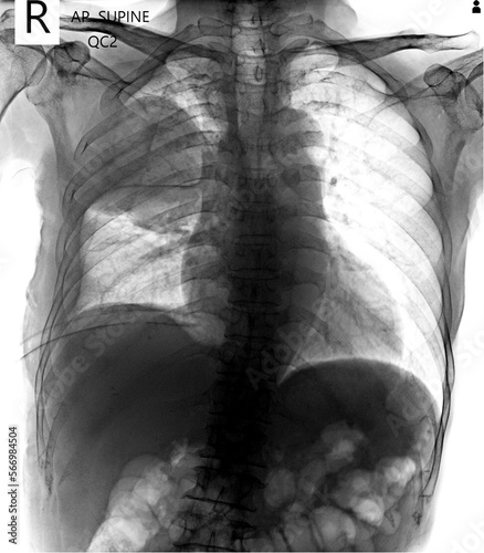 pneumothorax on ICD. chest x ray AP supine  photo