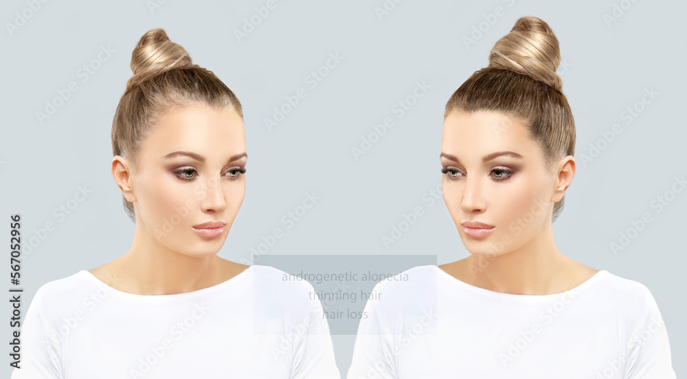 Alopecia Areata,female pattern baldness,Treatment for hair loss,Hair transplant,Surgery to implant artificial hairs Alopecia Areata,female pattern baldness,Treatment for hair loss,Hair transplant,Surgery to implant artificial hairs