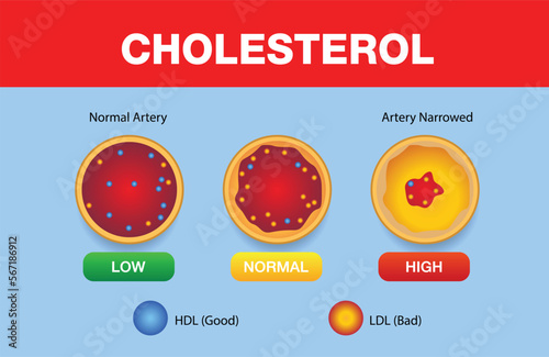 Cholesterol in artery, health risk , vector design