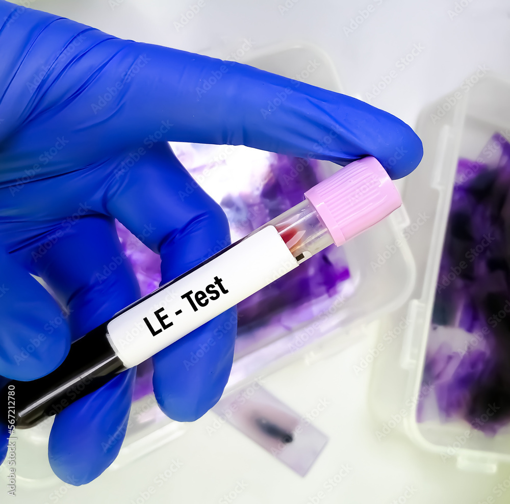Fotografia do Stock Blood sample for Lupus Erythematosus or LE test