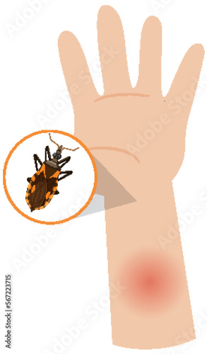 Human arm swollen from kissing bug bite