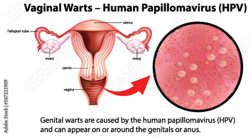 Vaginal Warts - Human Papillomavirus (HPV) infographic with explanation