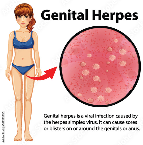 Genital Herpes infographic with explanation