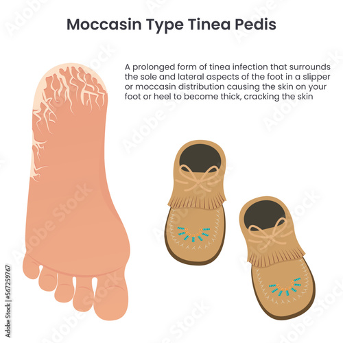 Moccasin type tinea pedis athlete's food education vector infographic