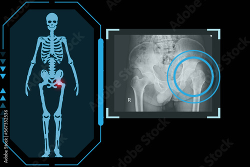 Examines a technological digital holographic plate representing the patient's body, Osteoarthritis of the Hip, Concept: Futuristic medicine, Medical technology concept.