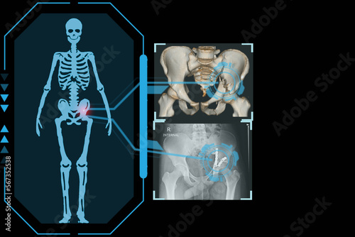 Examines a technological digital holographic plate representing the patient's body, Transverse fracture of acetabulum pelvis, Concept: Futuristic medicine, Medical technology concept.