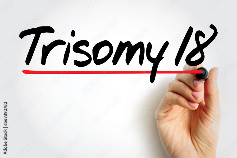 Trisomy 18 (Edwards syndrome) is a chromosomal condition associated