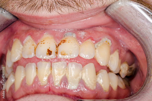 frontal, intraoral, mundhygiene photo