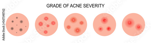 Grade of acne severity. Medical diagram different types acne. Blackheads, whiteheads, papules, pustules, cystic and nodular.
