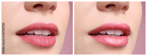 Collage with photos of woman before and after using lip balm on pink background, closeup