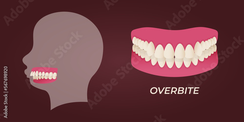 Human teeth malocclusion set with realistic images of mouth jaws with crooked teeth and text captions. Normal and abnormal occlusion. Vector illustration