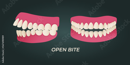 Human teeth malocclusion set with realistic images of mouth jaws with crooked teeth and text captions. Normal and abnormal occlusion. Vector illustration