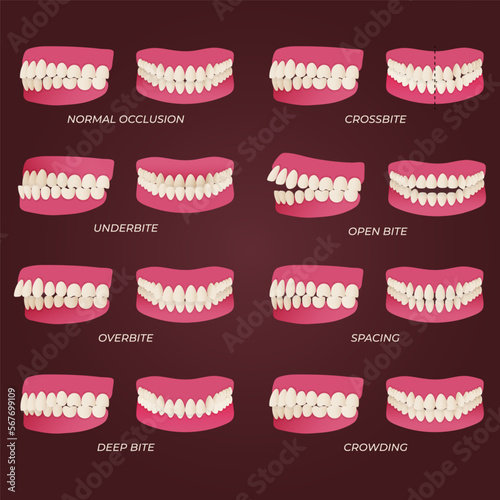 Human teeth malocclusion set with realistic images of mouth jaws with crooked teeth and text captions. Normal and abnormal occlusion. Vector illustration photo