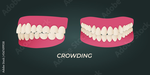Human teeth malocclusion set with realistic images of mouth jaws with crooked teeth and text captions. Normal and abnormal occlusion. Vector illustration