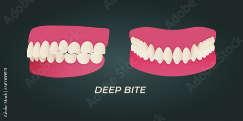 Human teeth malocclusion set with realistic images of mouth jaws with crooked teeth and text captions. Normal and abnormal occlusion. Vector illustration