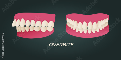 Human teeth malocclusion set with realistic images of mouth jaws with crooked teeth and text captions. Normal and abnormal occlusion. Vector illustration