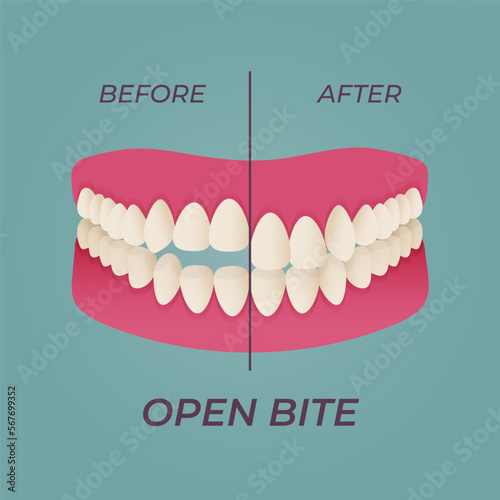 Medical dental diagram illustration. Orthodontist human tooth anatomy. Vector infographics with teeth diagrams.