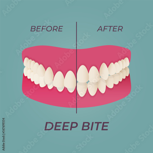 Medical dental diagram illustration. Orthodontist human tooth anatomy. Vector infographics with teeth diagrams.