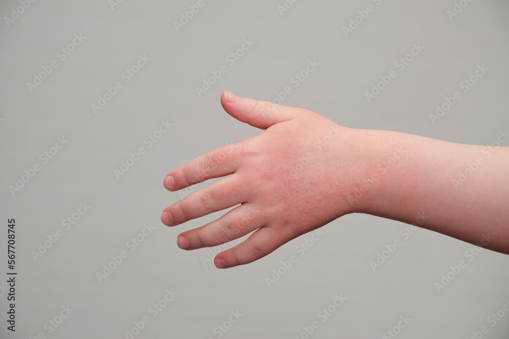 The child scratches atopic skin. Dermatitis, diathesis, allergy on the child's body.irritation and pruritus. The child scratches atopic skin. Dermatitis, diathesis, allergy on the child's body.irritation and pruritus.