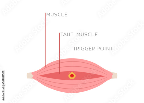 Illustration of tight muscle fibers with trigger point isolated on white background. Concept of injury, muscle pain, Myofascial pain, medical illustration. Flat vector.