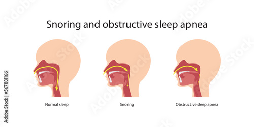 Snoring and obstructive sleep apnea