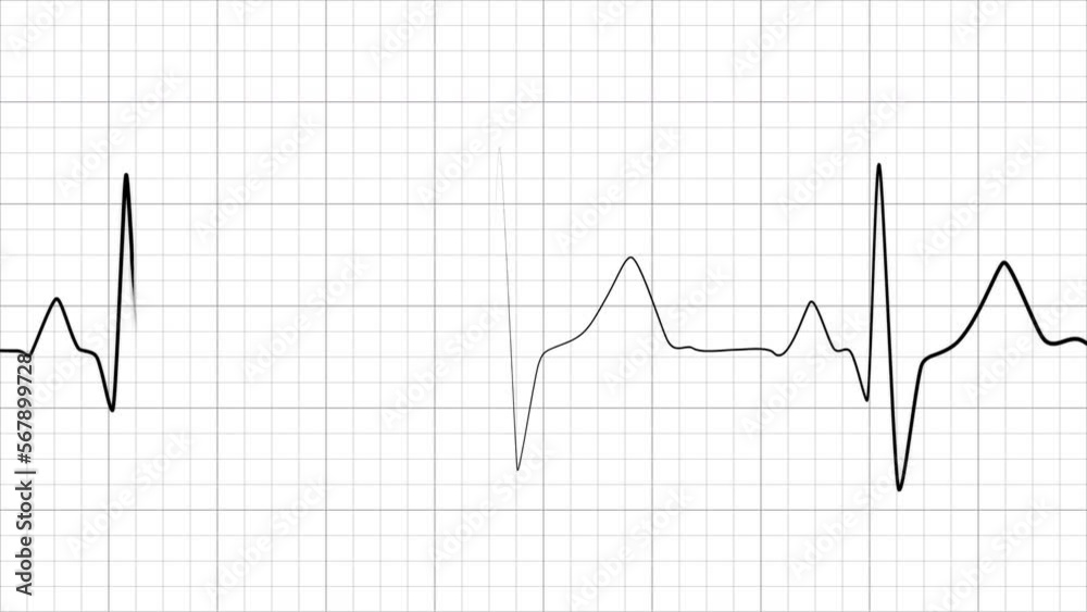 Dynamic heart rate or heart beat line. Cardiogram signal. Monochrome, black and white colors. Patient’s vital signs. Pulse measuring. Medical 4K footage. Dynamic heart rate or heart beat line. Cardiogram signal. Monochrome, black and white colors. Patient’s vital signs. Pulse measuring. Medical 4K footage.