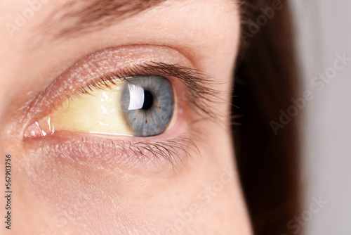 Woman with yellow eyes, closeup view. Symptom of hepatitis photo