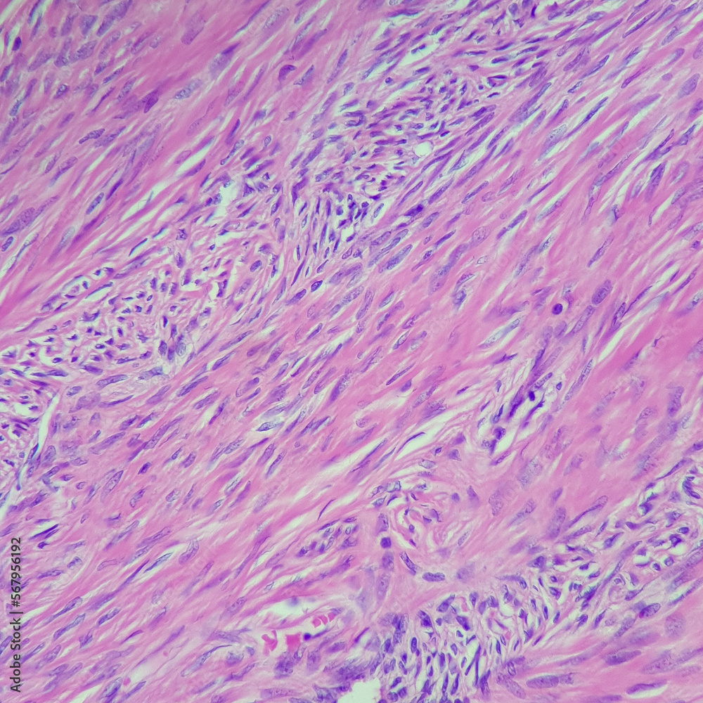 Camera photo of ovarian fibroma, showing proliferative spindle cells with fascicular pattern, magnification 400x, photograph through a microscope Camera photo of ovarian fibroma, showing proliferative spindle cells with fascicular pattern, magnification 400x, photograph through a microscope