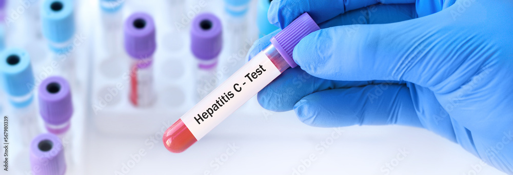Naklejka premium The doctor holds a test blood sample tube positive with hepatitis C virus (HCV) test on the background of medical test tubes. Banner