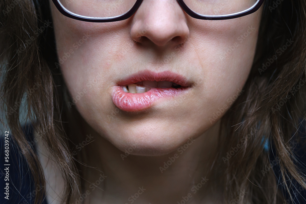 Cropped image of womans face biting skin on dry chapped lips Cropped image of womans face biting skin on dry chapped lips