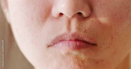 woman acne problem on face