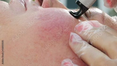 Cosmetologist curing rosacea or couperosis with modern laser technology in beauty clinic, doctor using highly efficient method of removing capillary on face skin, facial beauty treatment. 4 k video