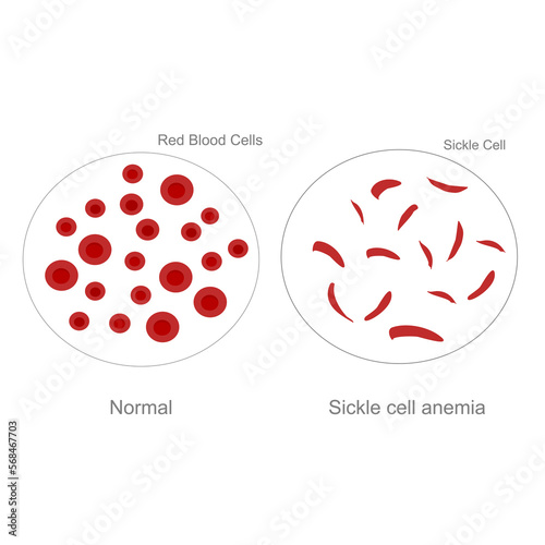The difference morphology of Red Blood cells between Normal cells and sickle cells in sickle cell anemia disorder.
