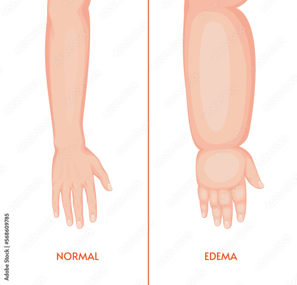 Edema arm. Swollen hand, fingers, wrist, forearm Stock ベクター Adobe Stock