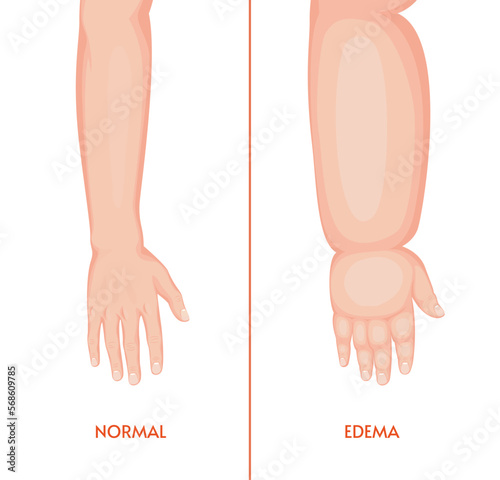 Edema arm. Swollen hand, fingers, wrist, forearm