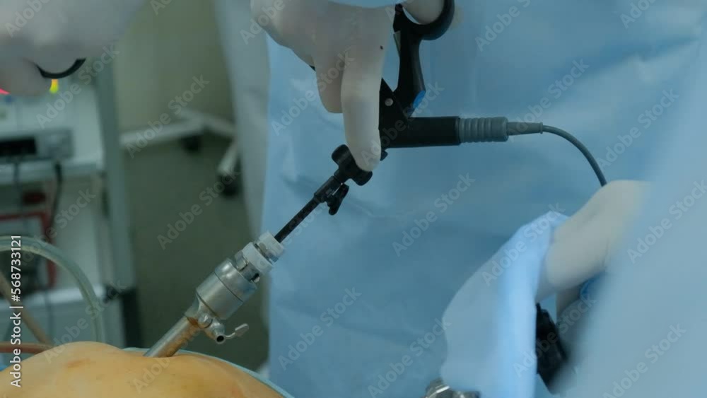 Laparoscopic cholecystectomy instrument. The surgeon's doing laparoscopic gastric sleeve surgery