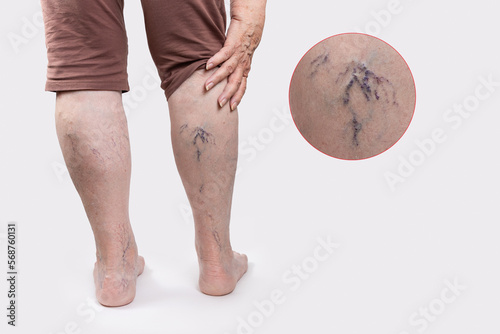 Varicosity. Close up view of old legs of woman with vascular asterisks. Zoomed area with blood vessels. White background with copy space. Back view. The concept of varicose veins