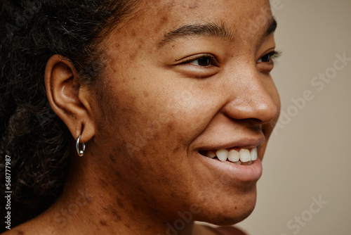 Canvastavla Close up ethnic young woman with acne scars on face smiling