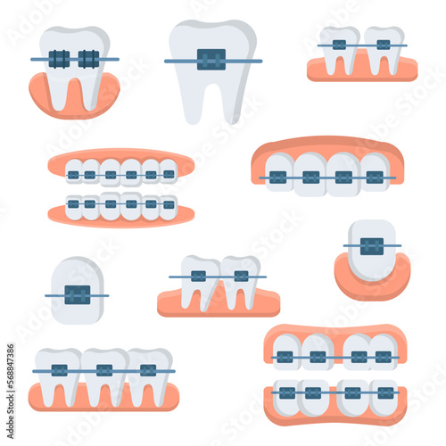 Set of cartoon style vector ceramic braces isolated on white background. Straight teeth, beautiful smile. Orthodontic treatment, dentistry services, teeth correction.